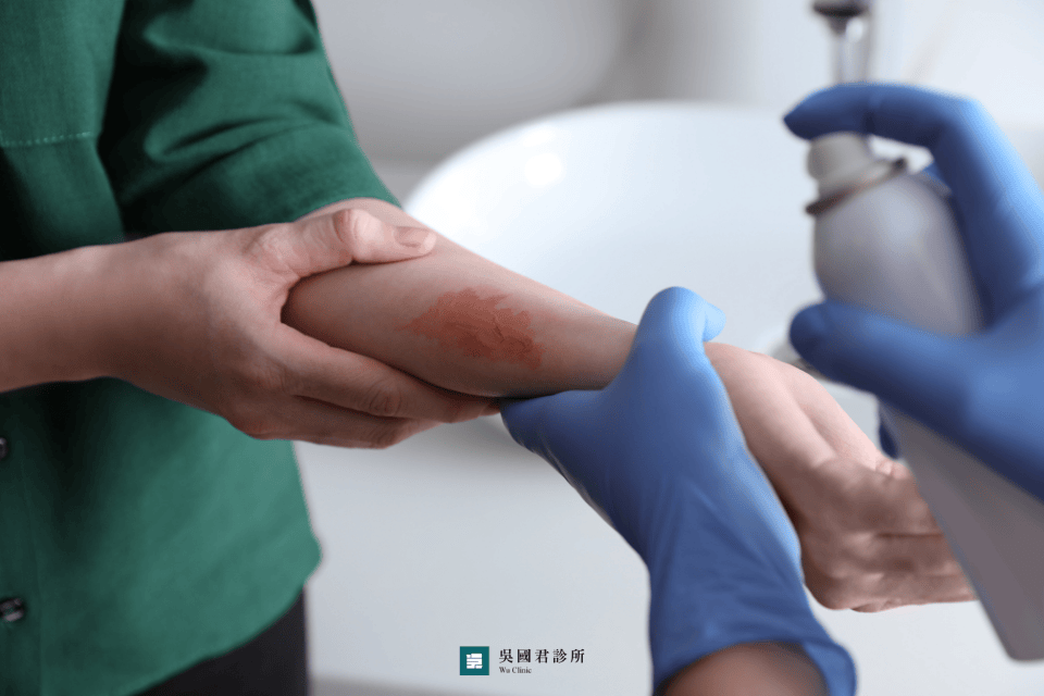 燙傷傷口變紅怎麼辦?燙傷紅紅的處理要小心,傷口反而易感染!